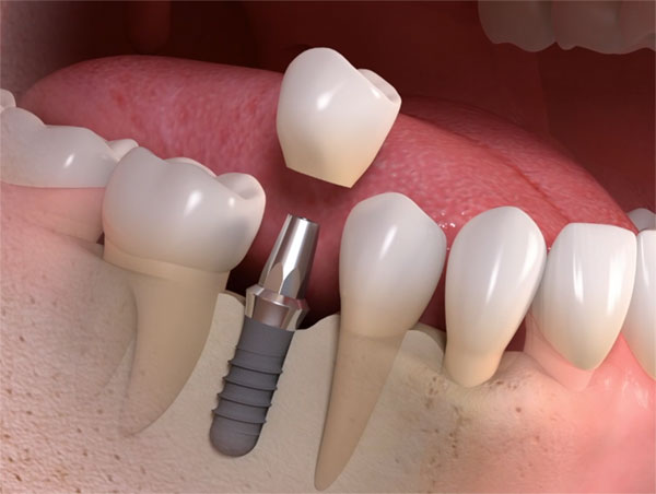 Ideal Dental Care