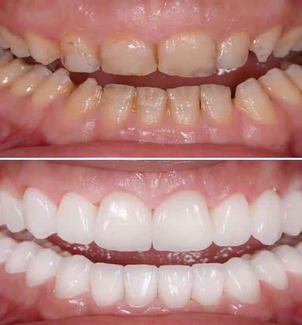 Full Mouth Rehabilitation