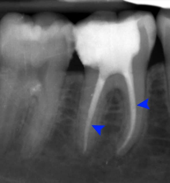 Painless Root Canal Treatment