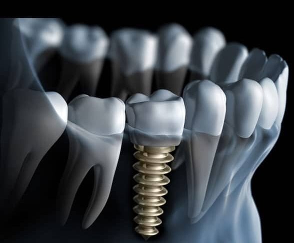 Dental Implant Indore