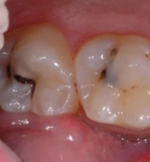 Pit and Fissure Sealants