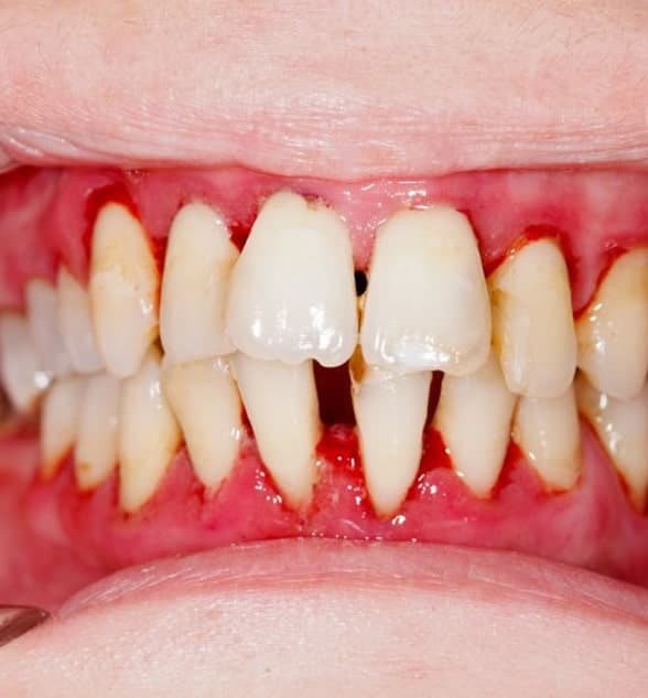 Advanced Gum Treatment