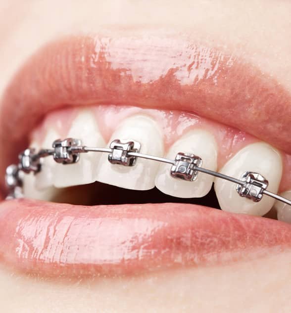 Dental Braces | Orthodontic Treatment Indore