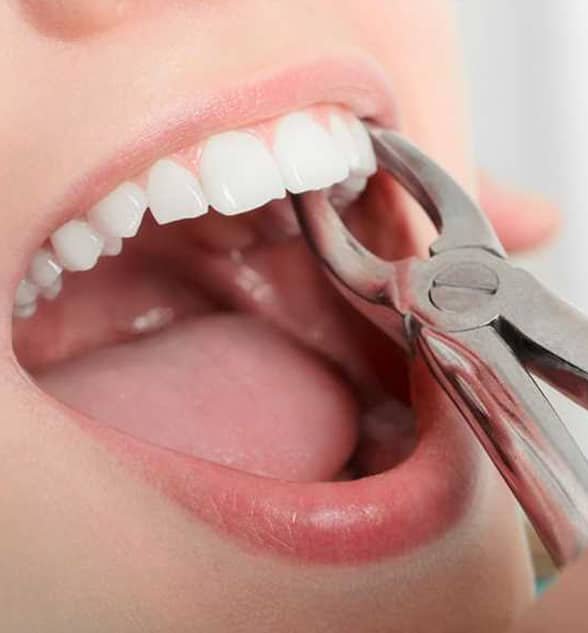 Extraction of Teeth