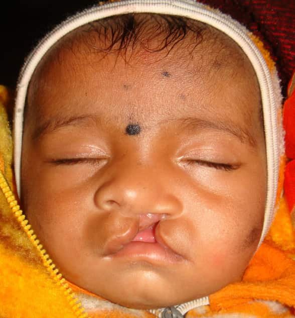 Facial Deformity Correction