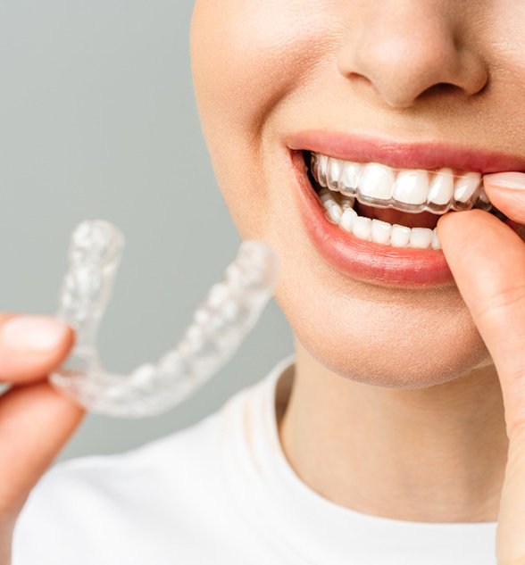 Invisible Aligners Indore