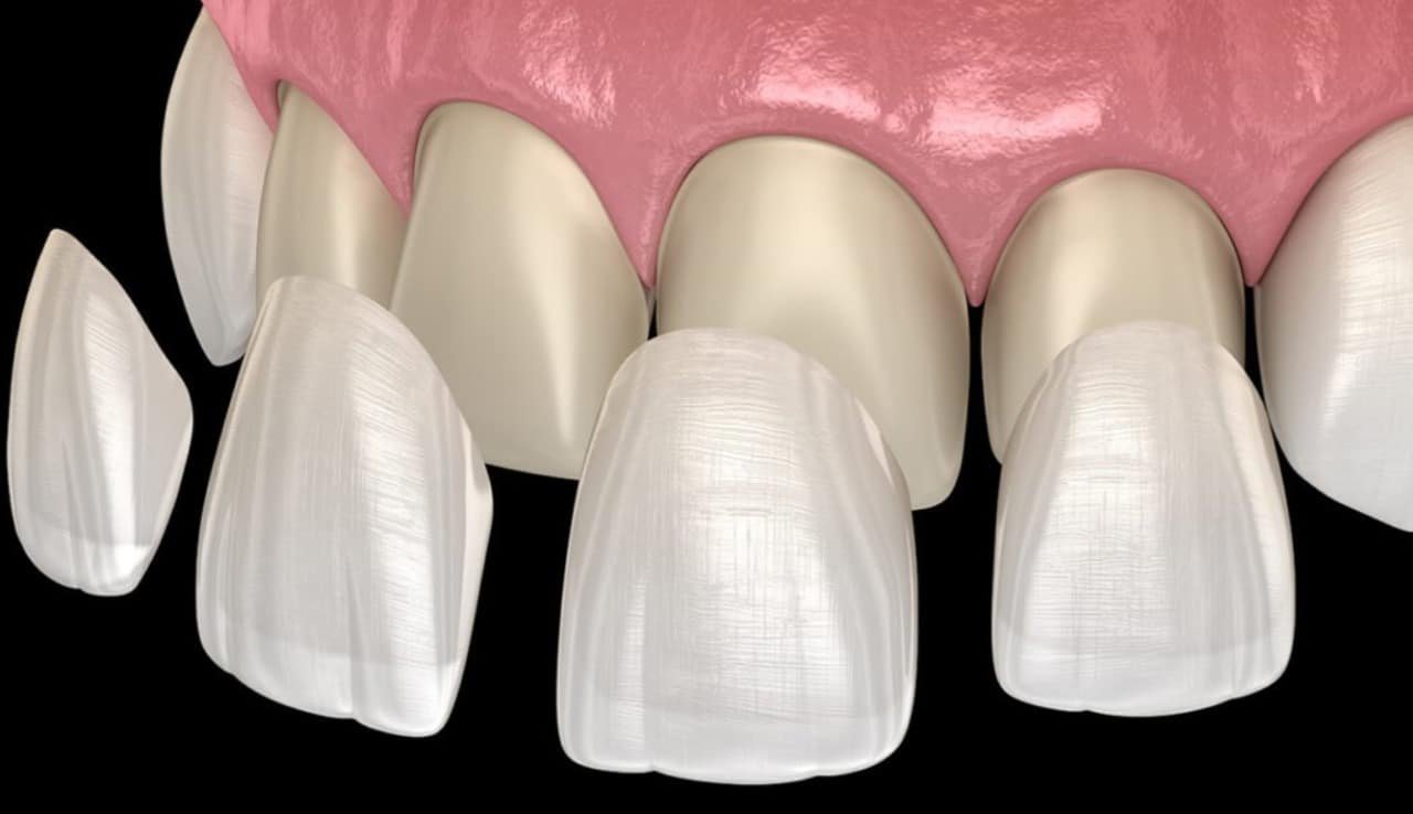Laminates and Veneers