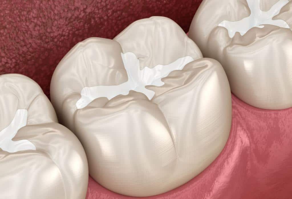 Dental Fillings