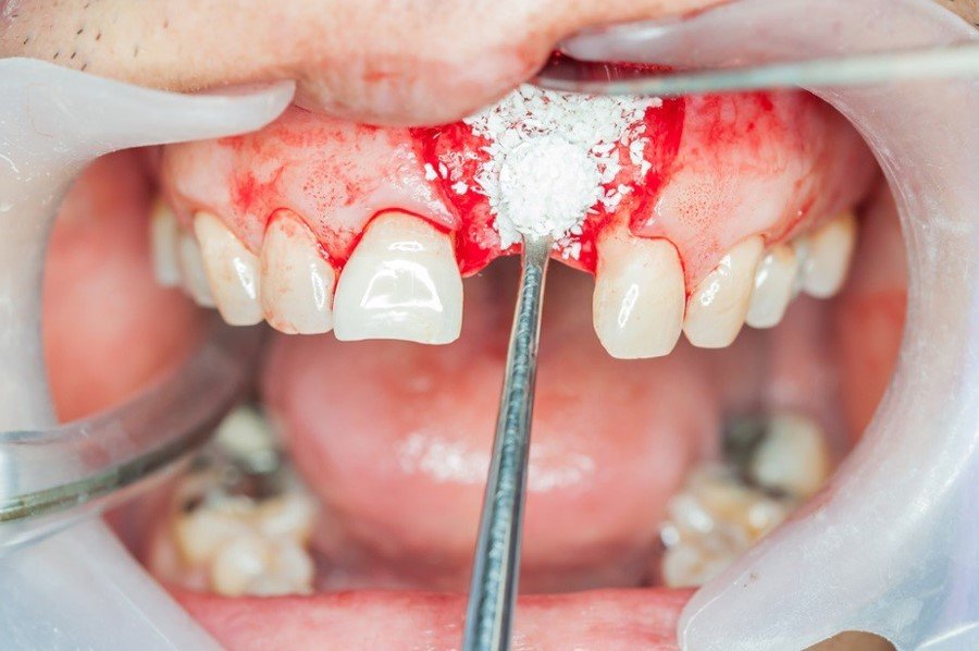 Advanced Bone Grafting Surgery