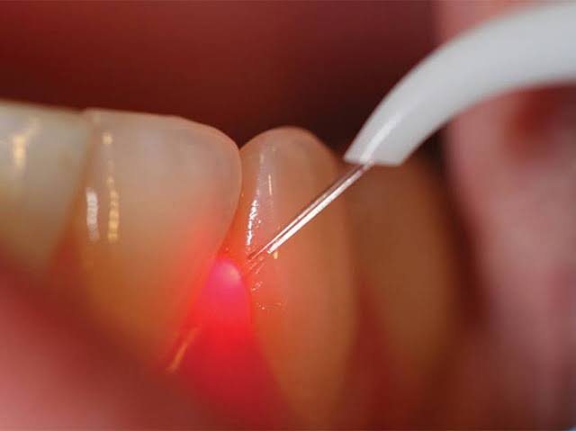 Laser Dentistry indore