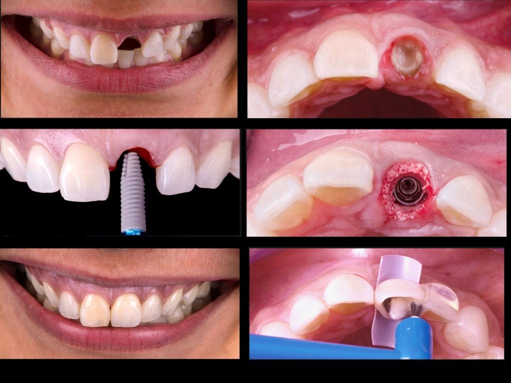 Same Day Dental Implants