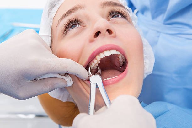 Wisdom Teeth Removal