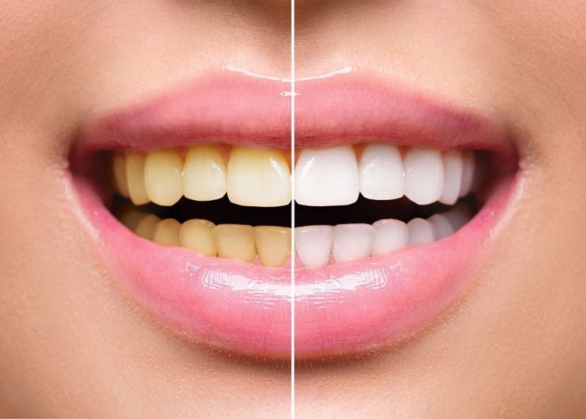 Teeth Cleaning & Teeth Whitening in Indore