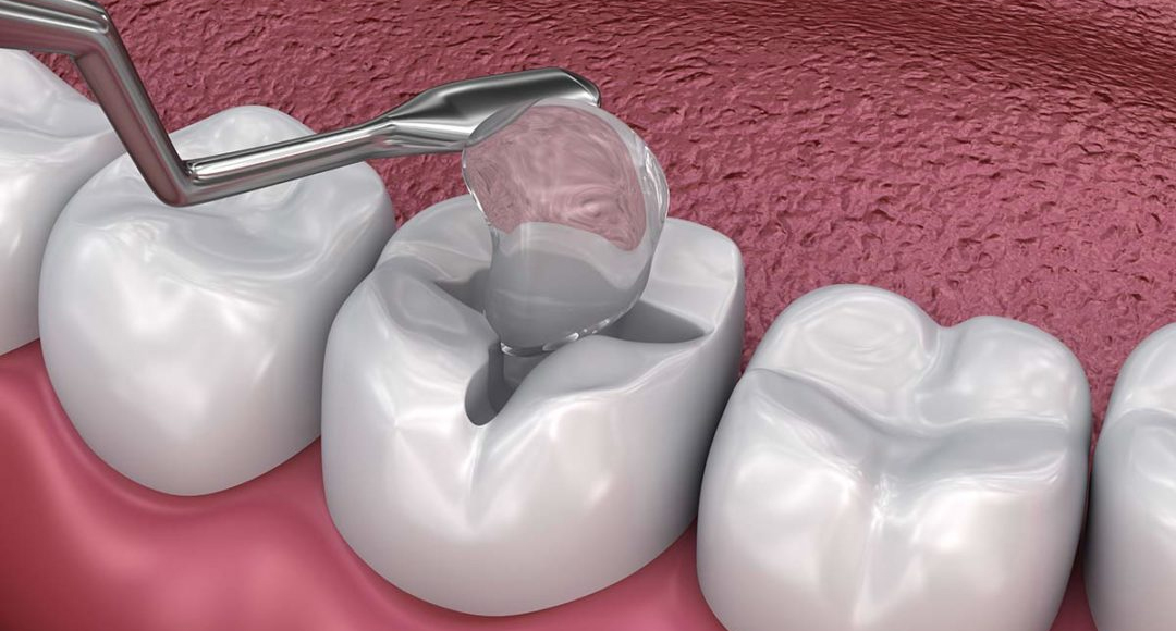 4 Benefits of Dental Fillings that you must know!