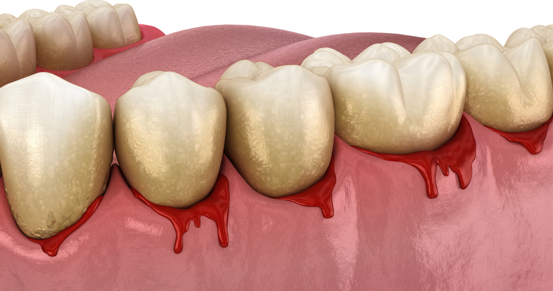 6 Amazing Tips to Prevent Sore, Swollen, and Bleeding Gums – Gum Problem Basics