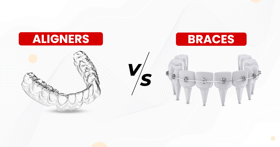 Aligners vs. Braces. Which One is Good For You?
