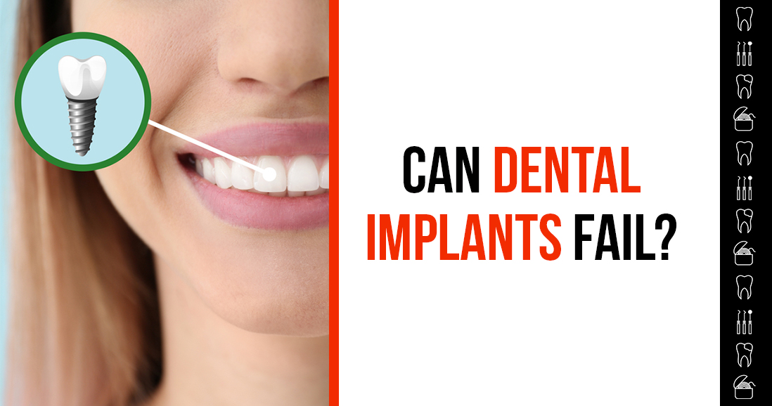 Can Dental Implants Fail?