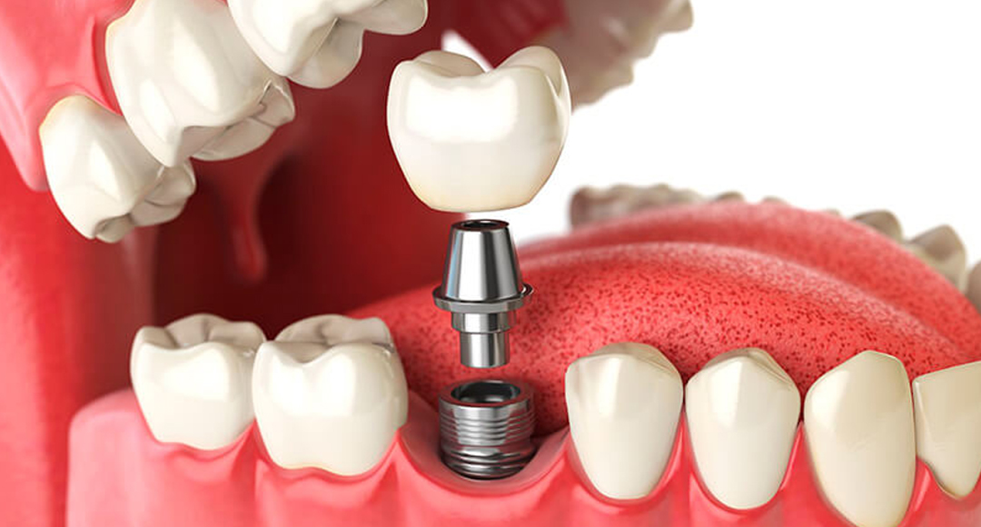 Dental Implants – Painless Dental Procedure with Countless Advantages!
