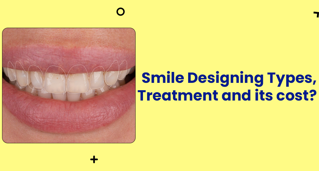 Smile Designing Types, Treatments and Its Cost?