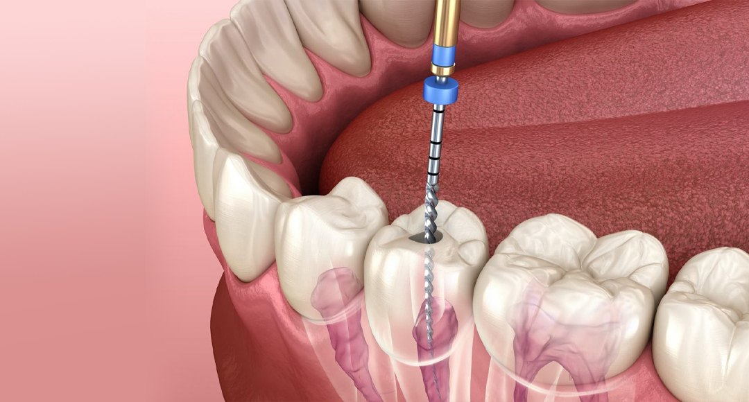 What Are Symptoms of Root Canal and What is Root Canal Treatment?