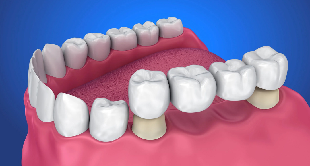 What are Dental Bridges? Who needs them & What are the Advantages?
