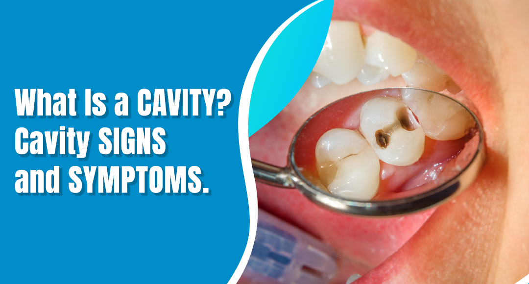 What Is a Cavity? Cavity Signs and Symptoms