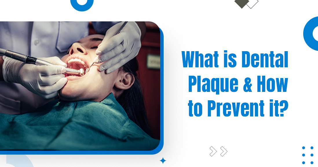 What is Dental Plaque & How to Prevent it?