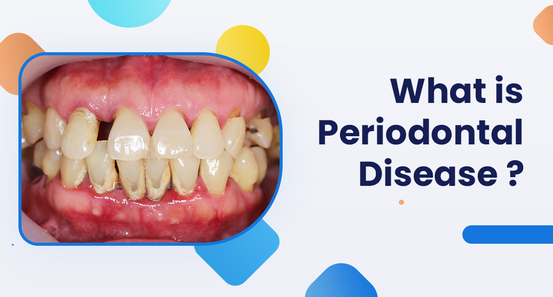 What Is Periodontal Disease – A Complete Guide