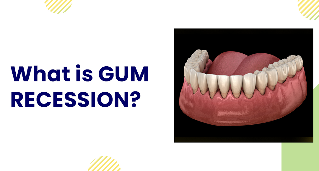 What is Gum Recession?
