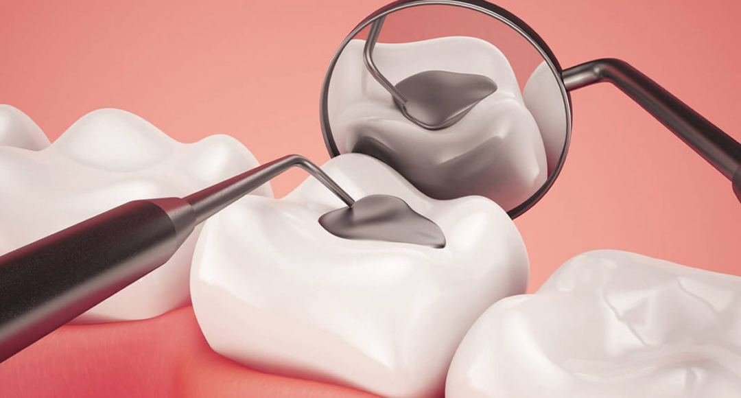 The Ultimate Guide to Dental Fillings: Everything You Need to Know