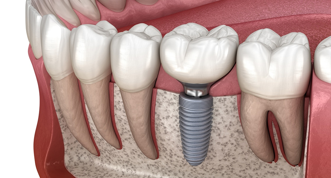 Complete Guide to Dental Implants: Everything You Need to Know