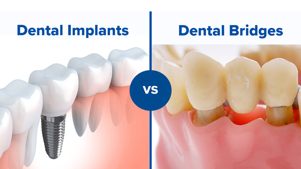 What’s better: Dental Implants or Dental Bridges?