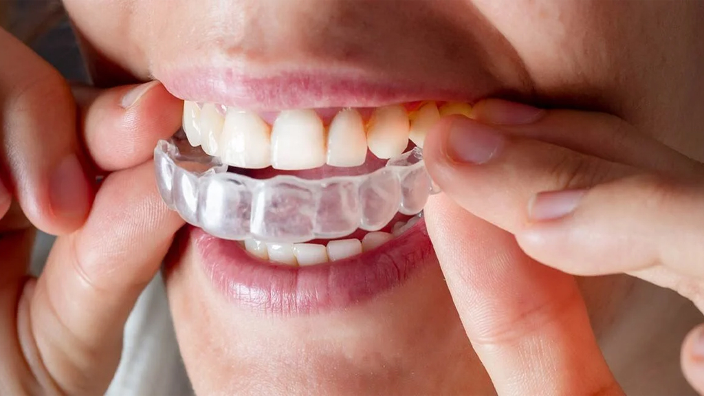 What is Invisalign?