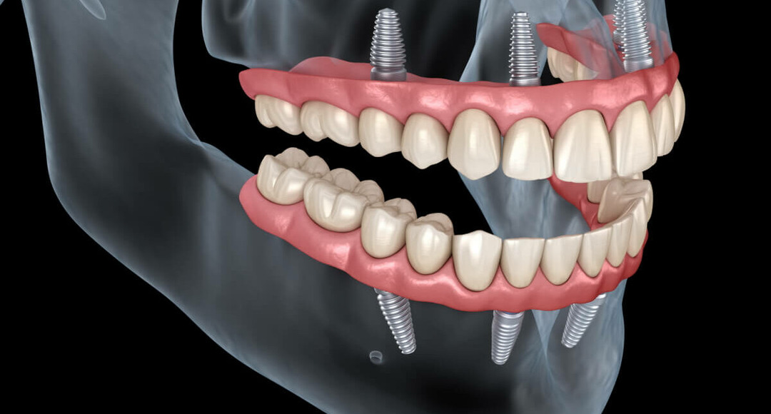 Achieving Optimal Dental Care with Single Dental Implant Placement